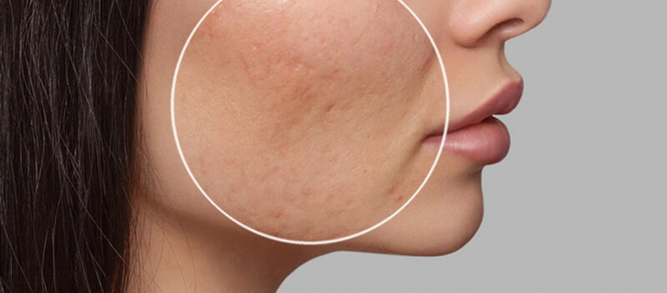 Ακμή μετά τα 30: Nα που μπορεί να οφείλεται